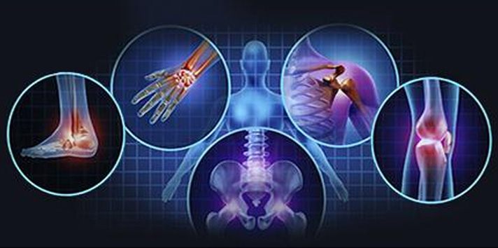 الباحثون السوريون الف صال العظمي التهاب المفاصل التنكسي Osteoarthritis