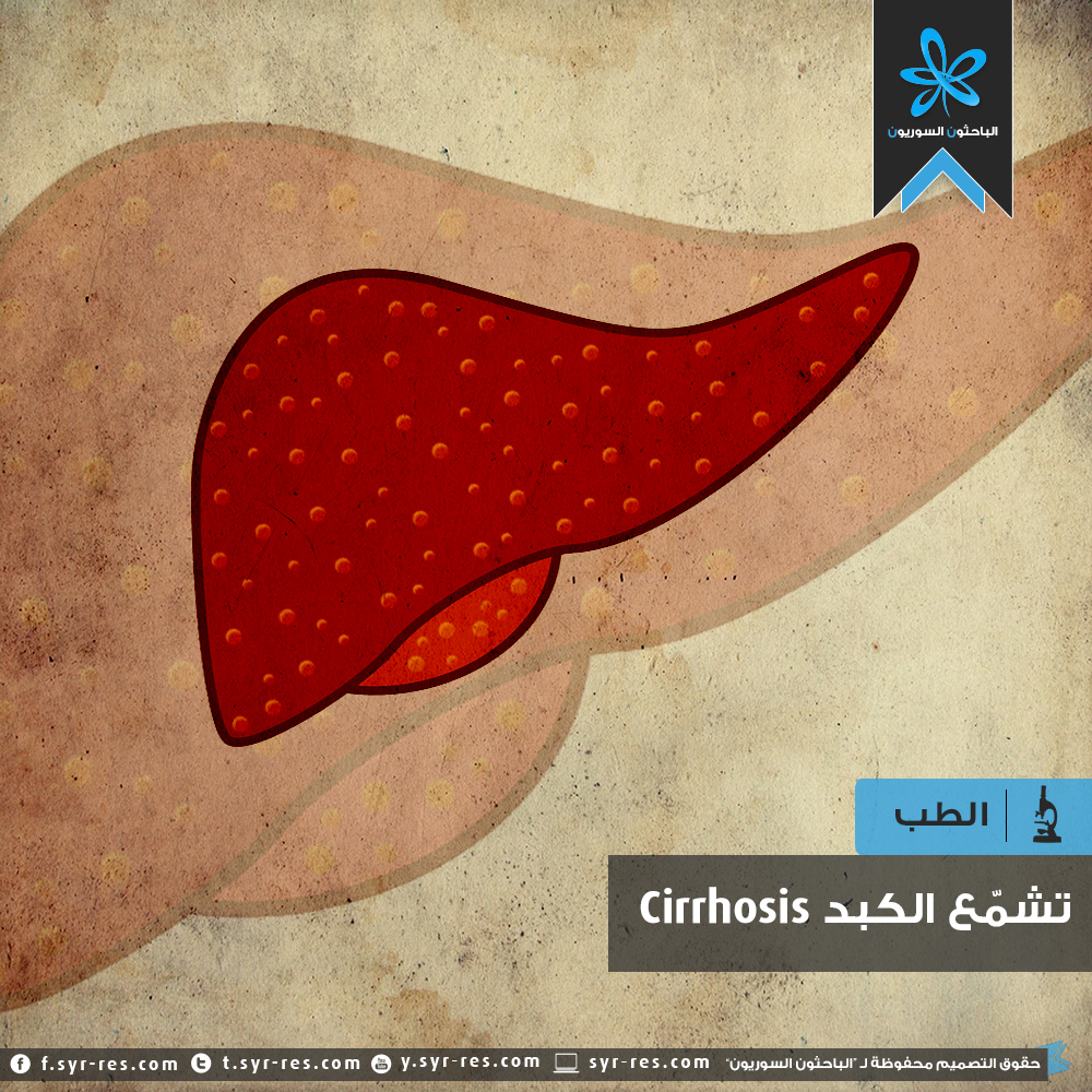 الباحثون السوريون تشم ع الكبد Cirrhosis