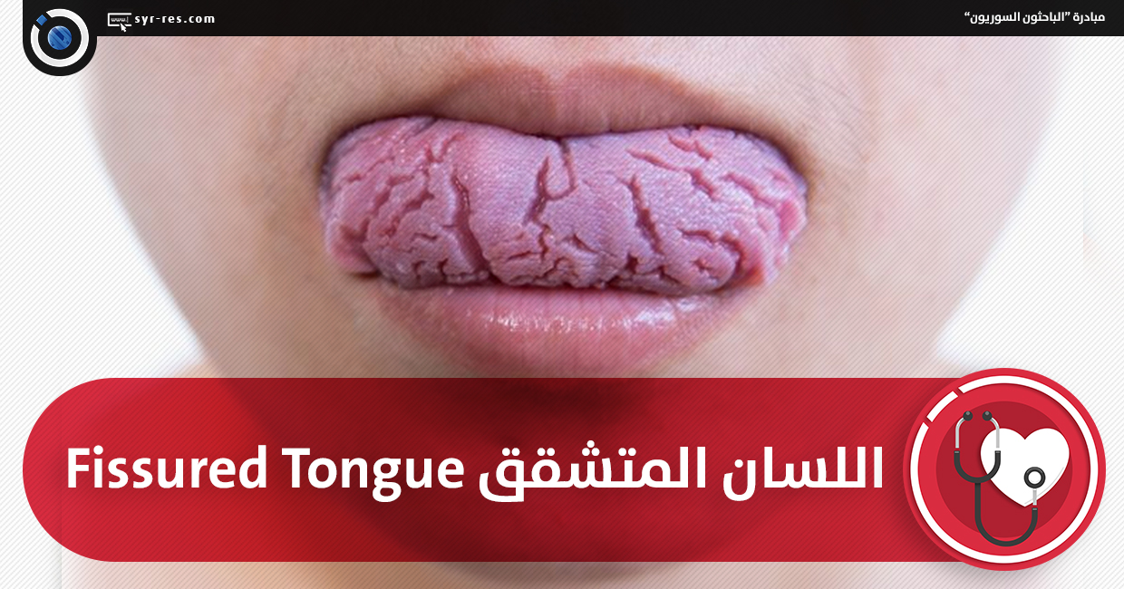 Ø§Ù„Ø¨Ø§Ø­Ø«ÙˆÙ† Ø§Ù„Ø³ÙˆØ±ÙŠÙˆÙ† Ø§Ù„Ù„Ø³Ø§Ù† Ø§Ù„Ù…ØªØ´Ù‚Ù‚ Fissured Tongue